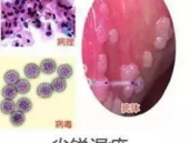 尖锐湿疣早期症状网,症状揭秘与预防指南